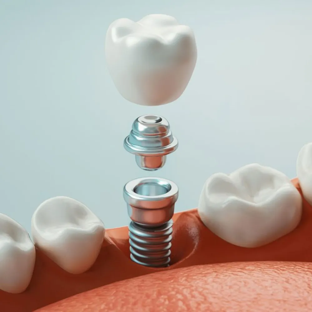 Dental Implants & Dentures