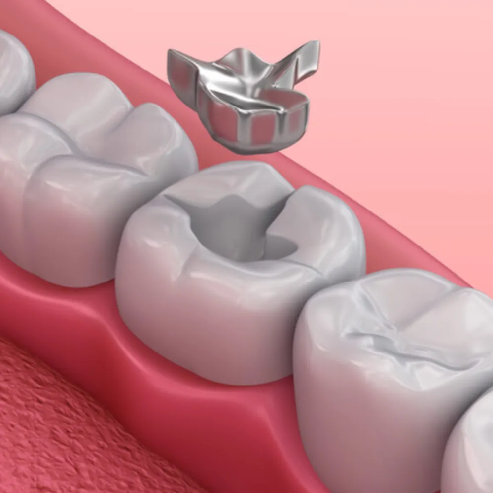 Loose Filling or Crown Repair