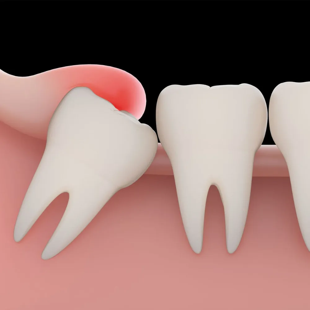 Wisdom Tooth Treatment