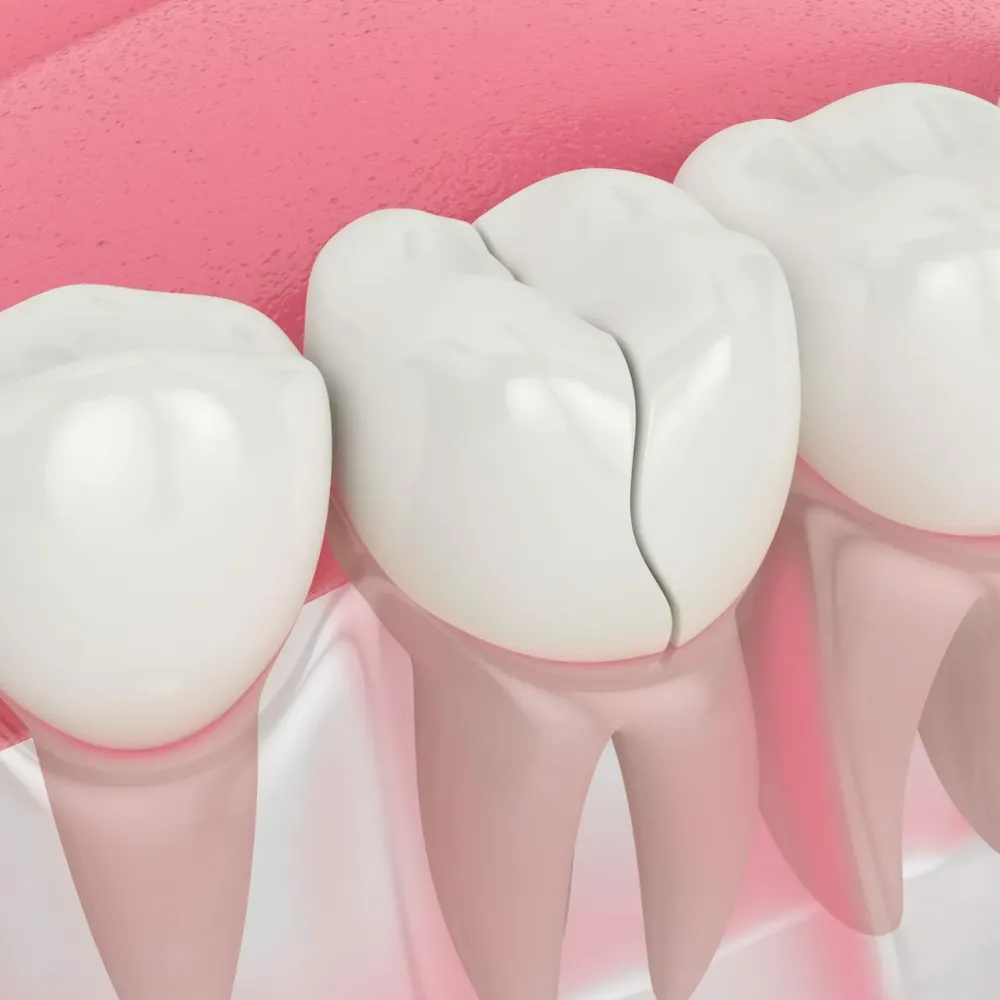 Broken or Cracked Tooth