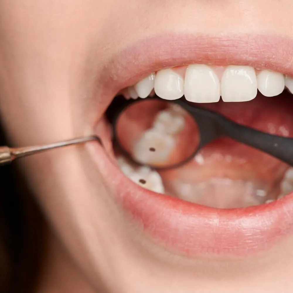 Cavity & Infection Treatment