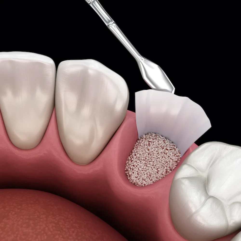 Bone Grafting Available