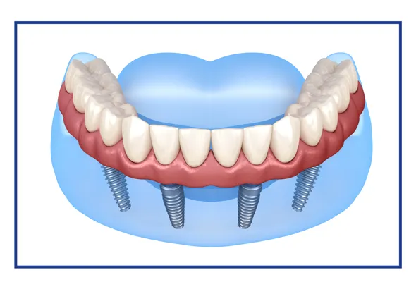 Non-Removable Dentures Supported by Implants