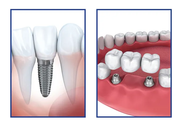 Conventional Implants for One or More Missing Teeth