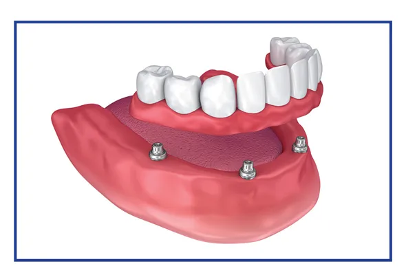 Removable Dentures Supported By Implants