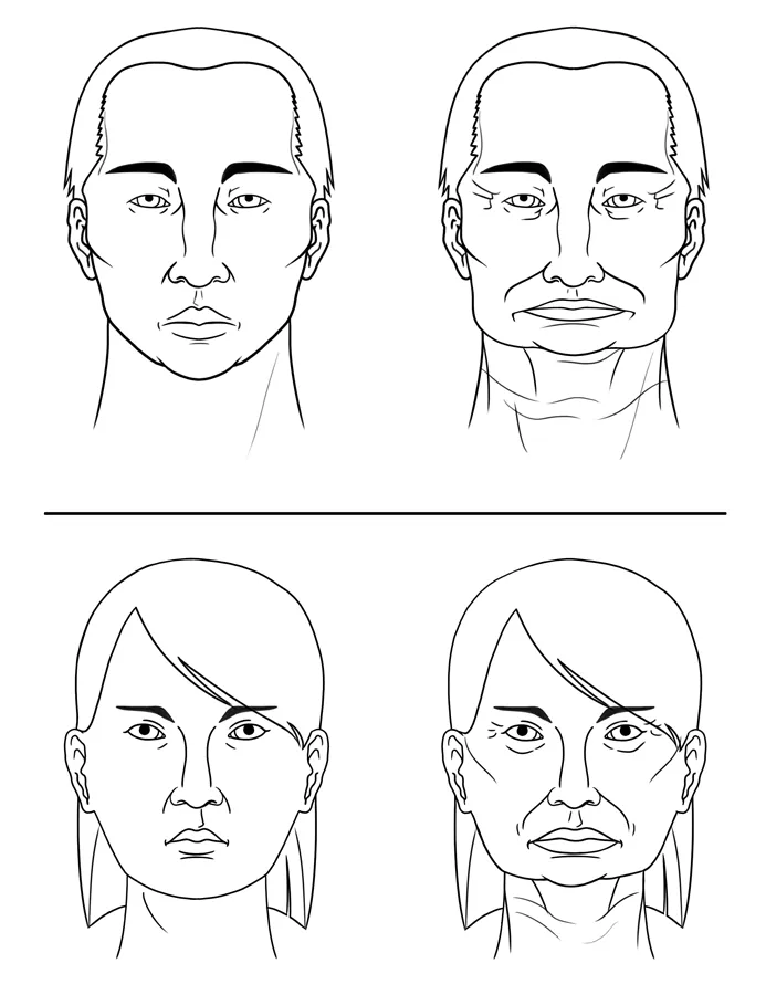 Before and after bone loss from  missing teeth in your jaw