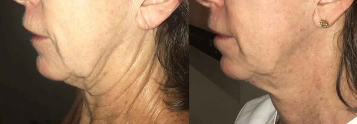 Morpheus8 Before & After