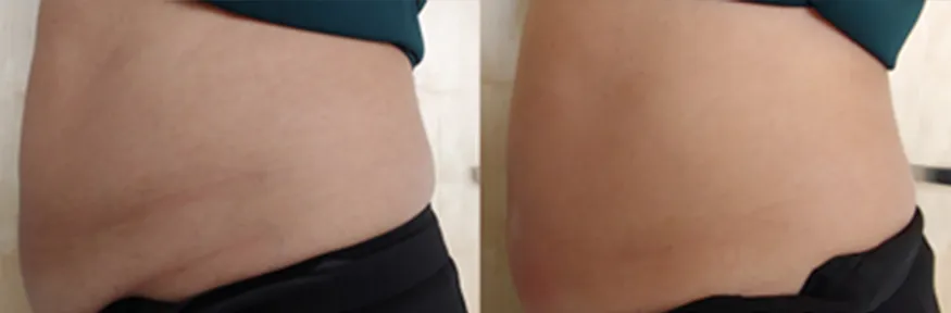 Allura Aesthetics Results