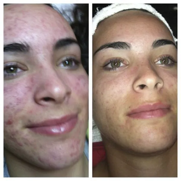 HydraFacial Before & After