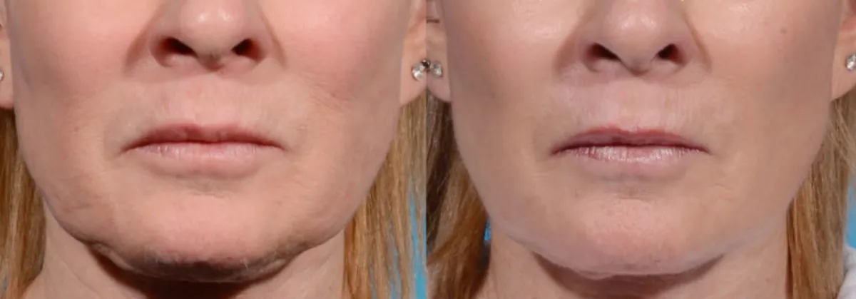 Morpheus8 Before & After