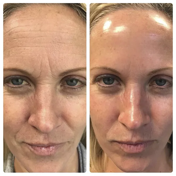 HydraFacial Before & After