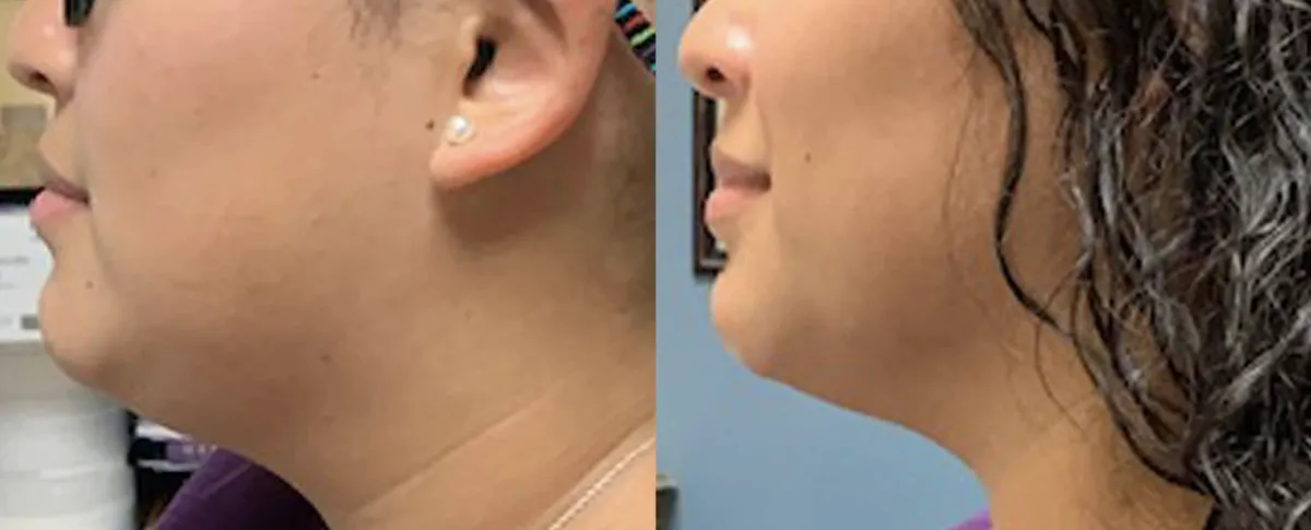 Allura Aesthetics Results