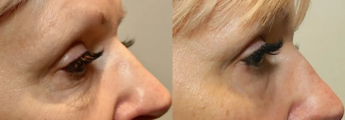 Morpheus8 Before & After