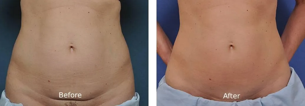 Determine If You're A Mini Tummy Tuck Candidate - Body By Craft