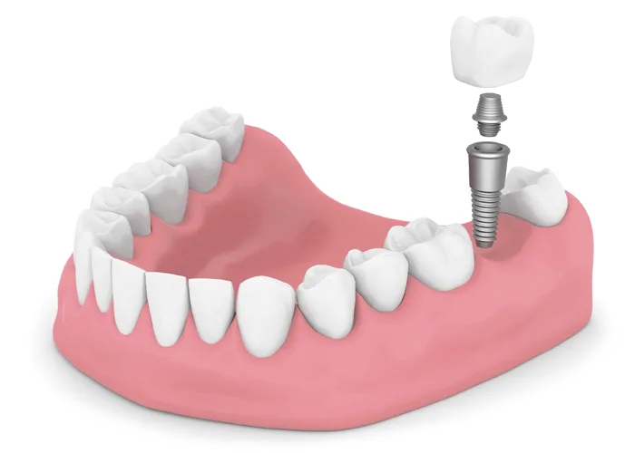 single tooth implant diagram
