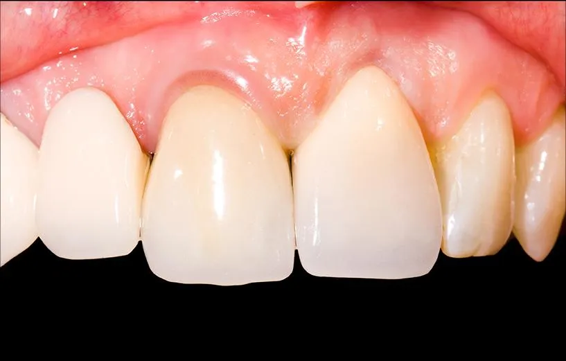 before and after dental implant patient