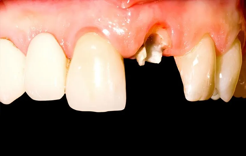 dental implant patient before and after