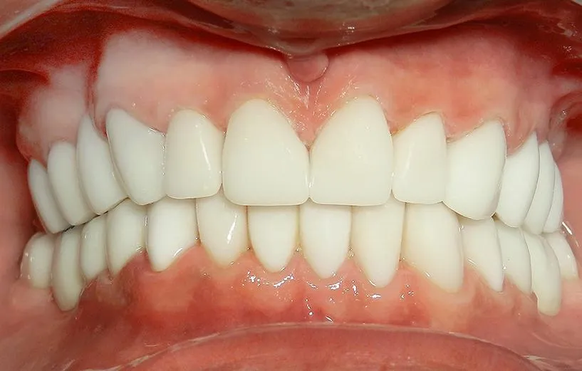 before and after dental implant patient