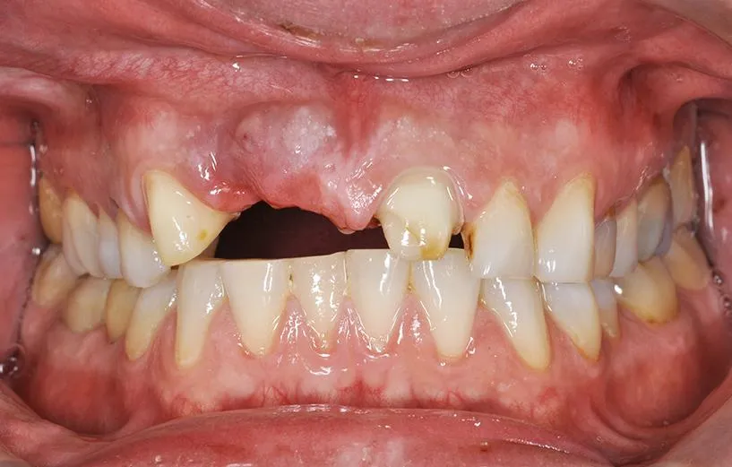 dental implant patient before and after