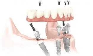 full arch implants diagram