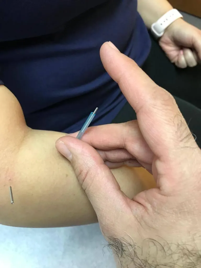 Acupuncture Needles