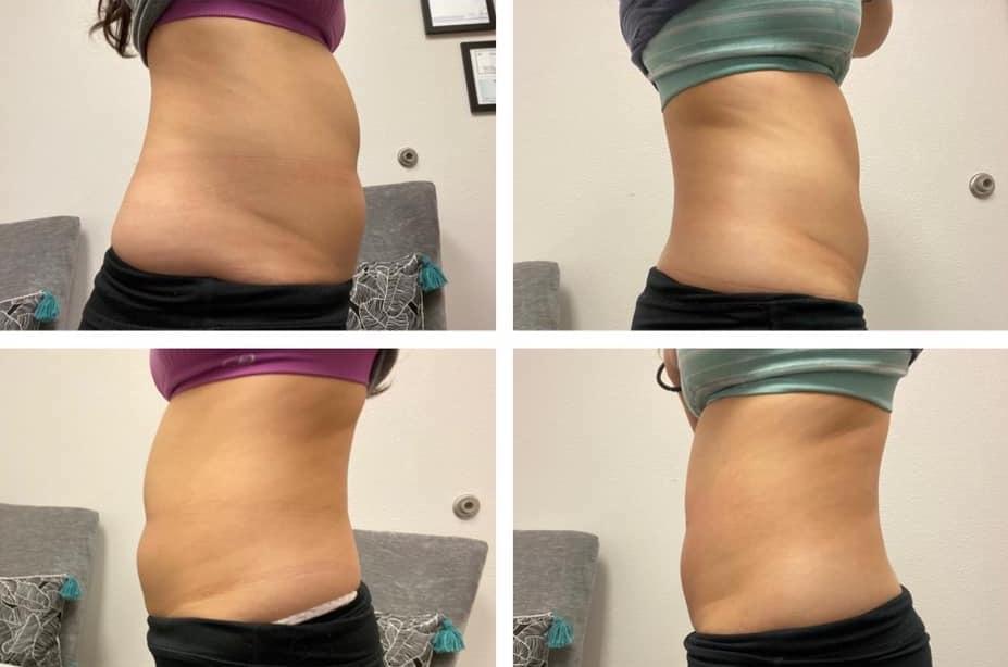 Cryoskin slimming treatments help clients eliminate unwanted fat