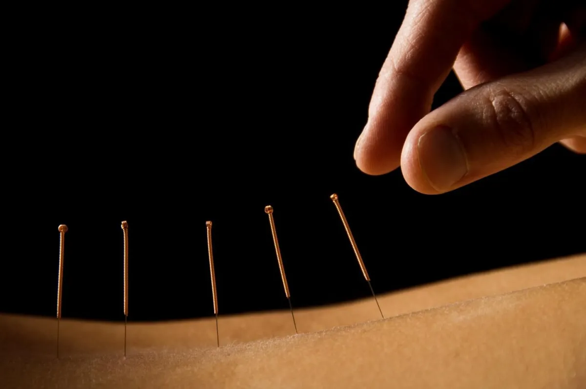 Health Source Acupuncture needling graphic
