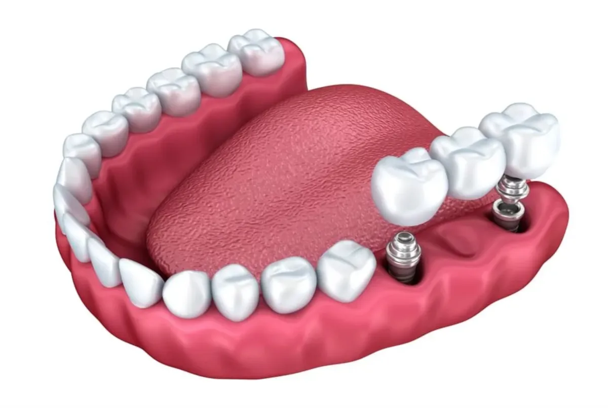 Dental Implants