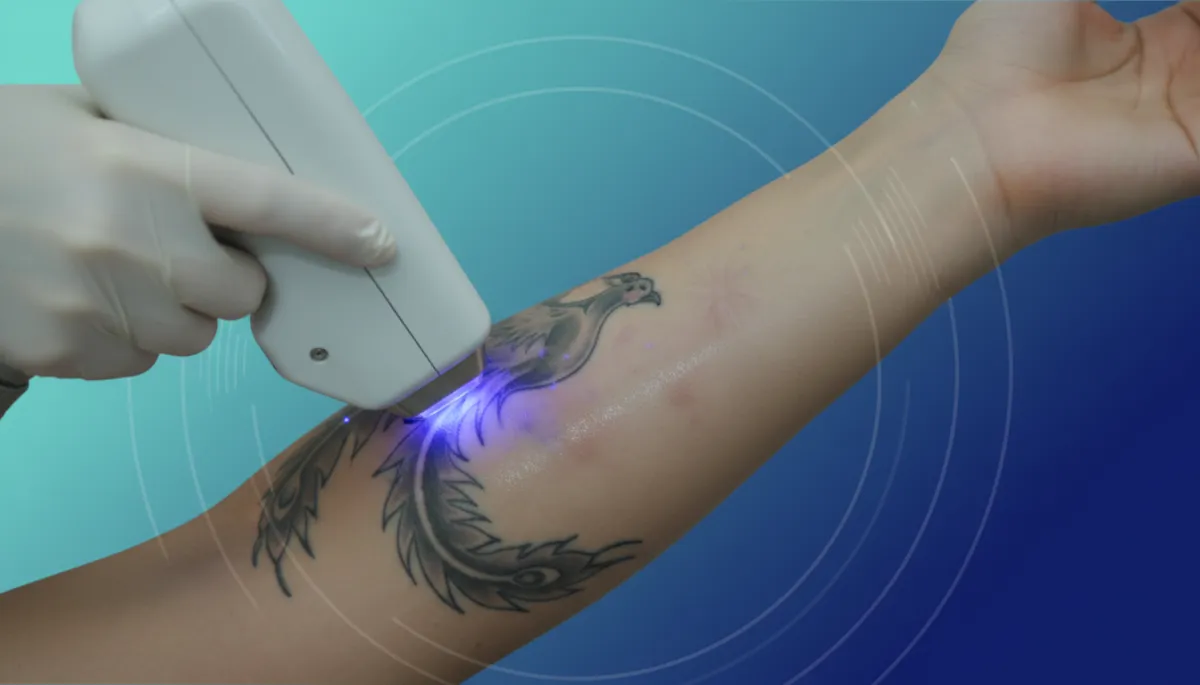 Dermatologist consulting patient on tattoo removal using a tablet