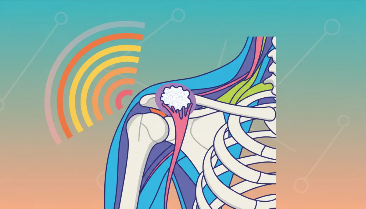 Diagram showing radial pressure waves losing intensity before reaching deep supraspinatus calcification Diagram showing radial pressure waves losing intensity before reaching deep supraspinatus calcification