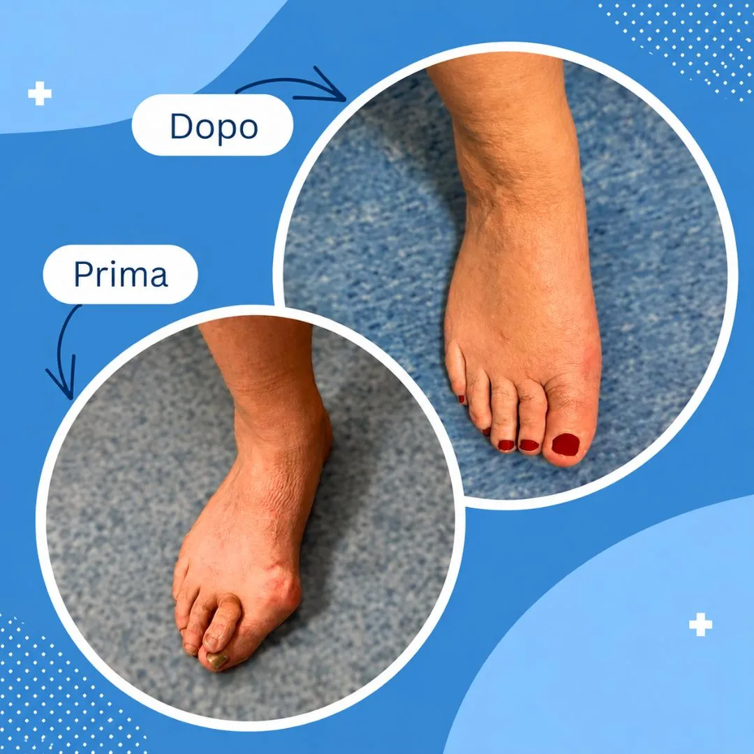Caso clinico Alluce valgo - Prima e Dopo