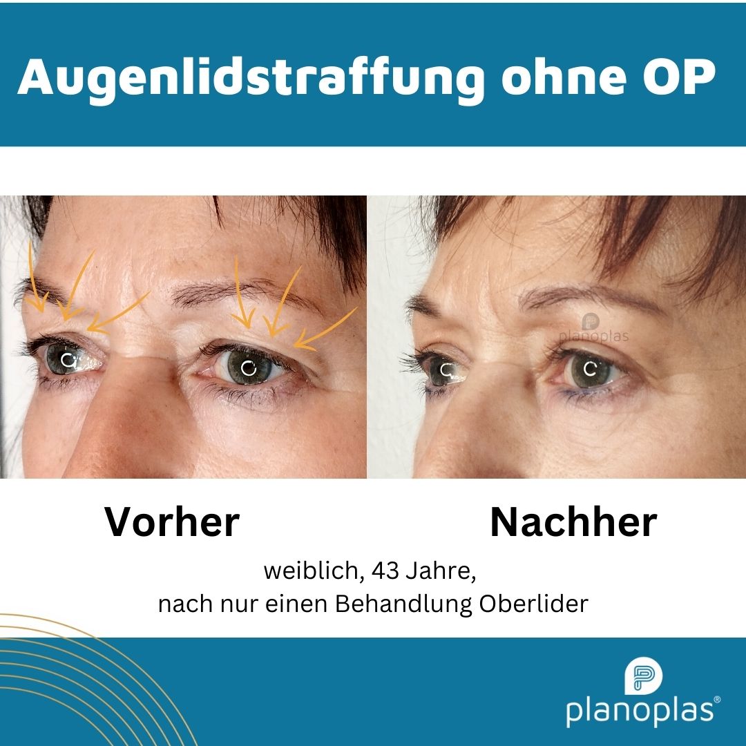 Schlupflider ohne OP?