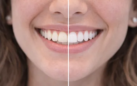 Whitening