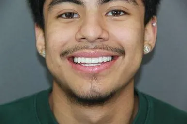 Teeth before and after result 1
