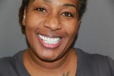 Teeth before and after result 2