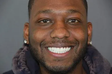 Teeth before and after result 3