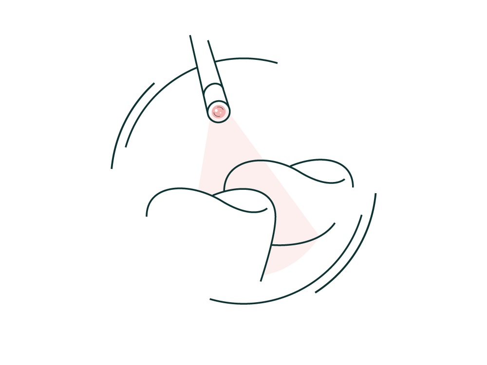 Gum treatment and perioscopy