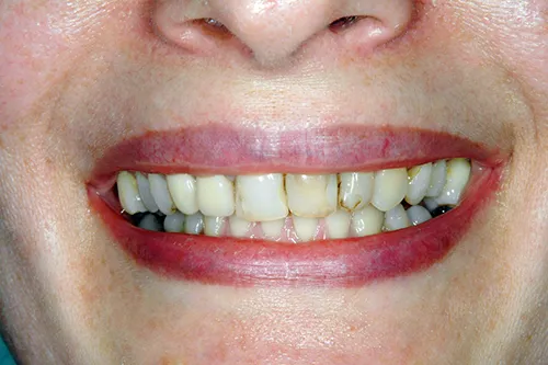 Before chipped front tooth