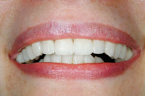 After chipped front tooth restoration