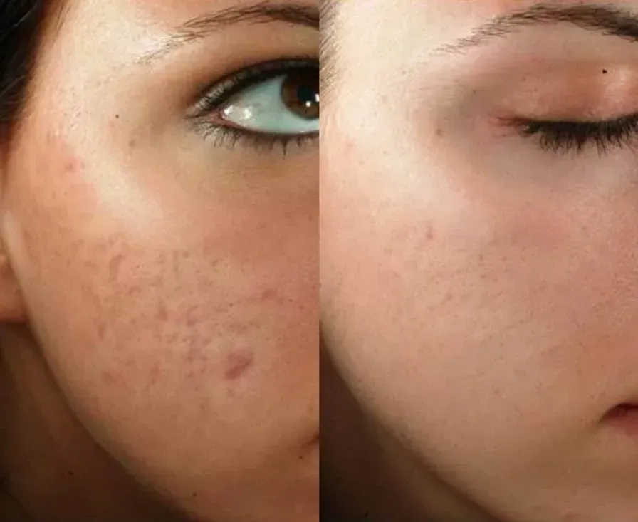 Microneedling