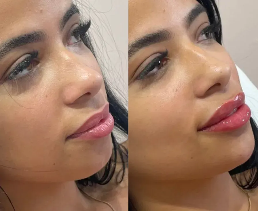 Lip Fillers