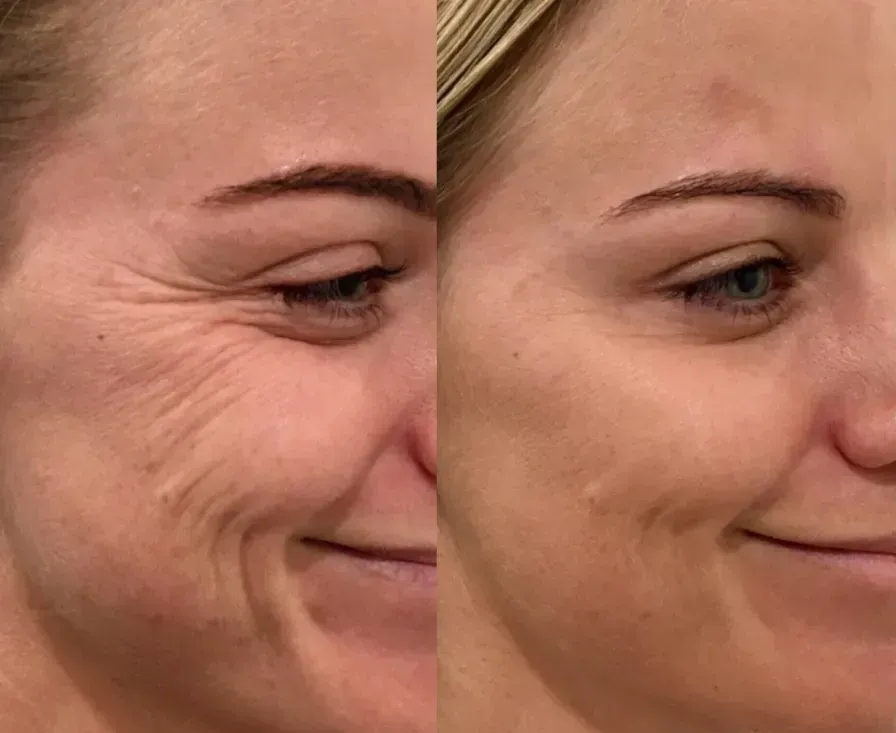 Botox / Wrinkle Relaxer