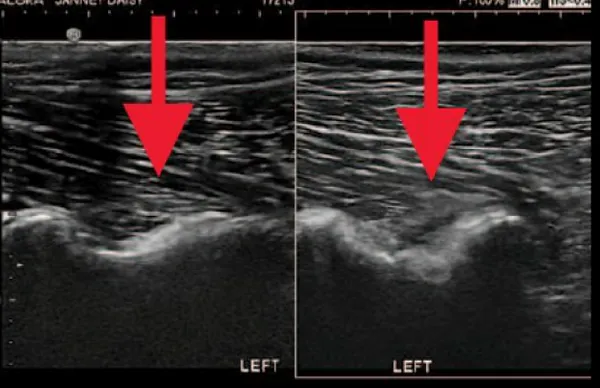 RETURN TO AGILITY AFTER ILIOPSOAS STRAIN