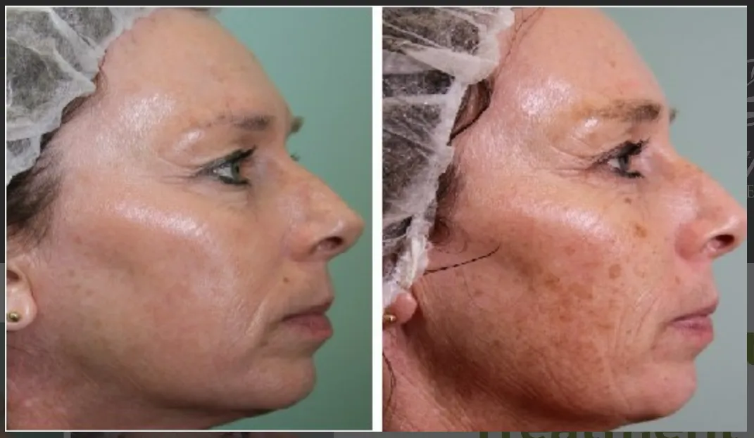 Facial treatment before and after - profile view