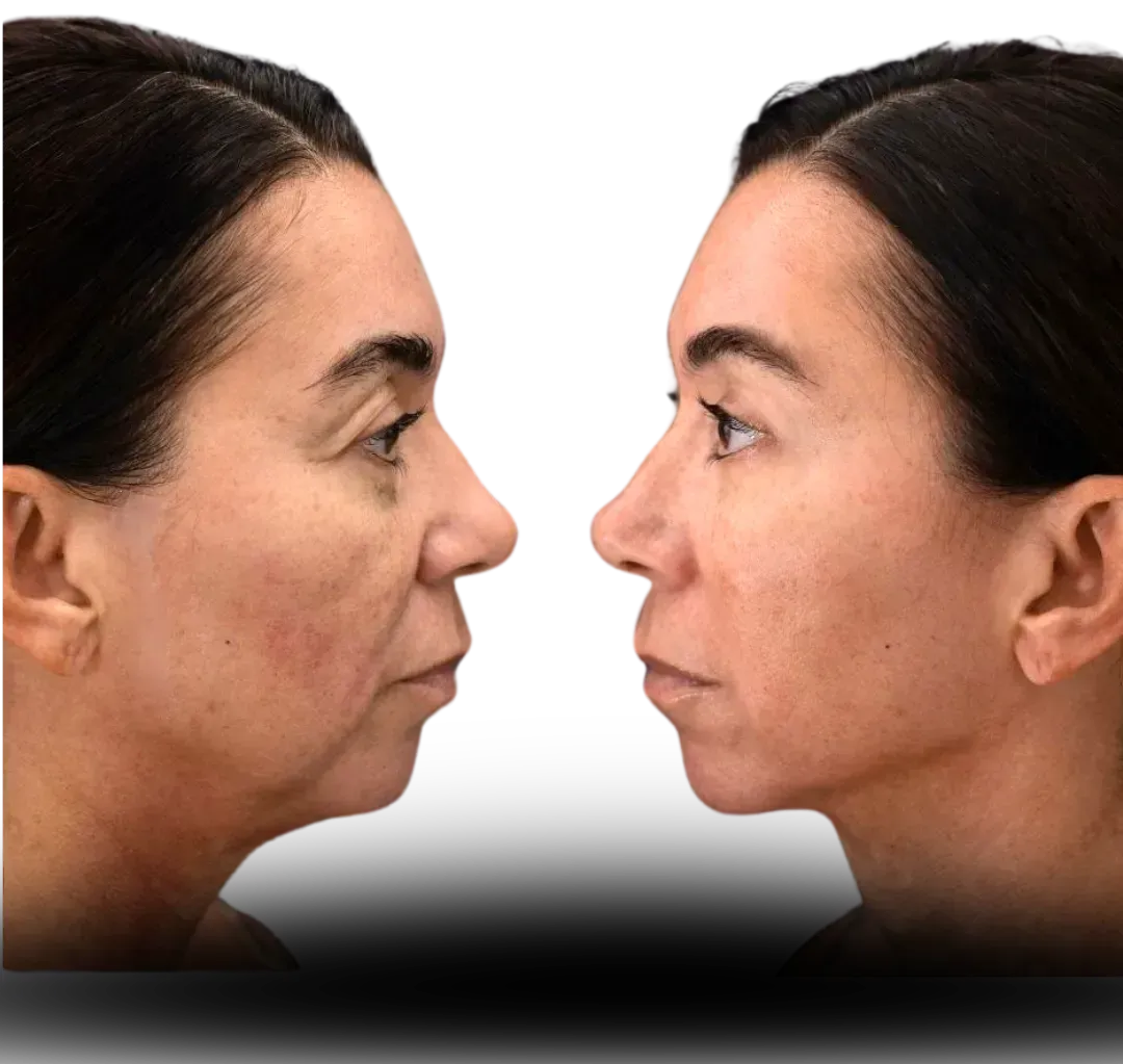 Tratamiento facial antes y despues