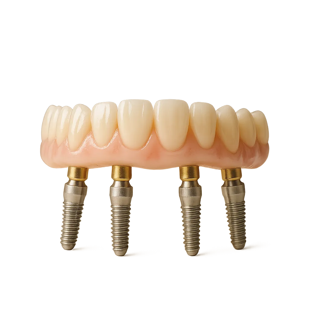 Clinical view of an All-on-4 implant structure