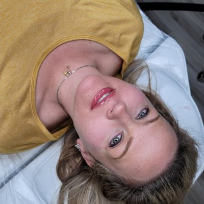 Plasma Fibroblast Skin Treatment Example