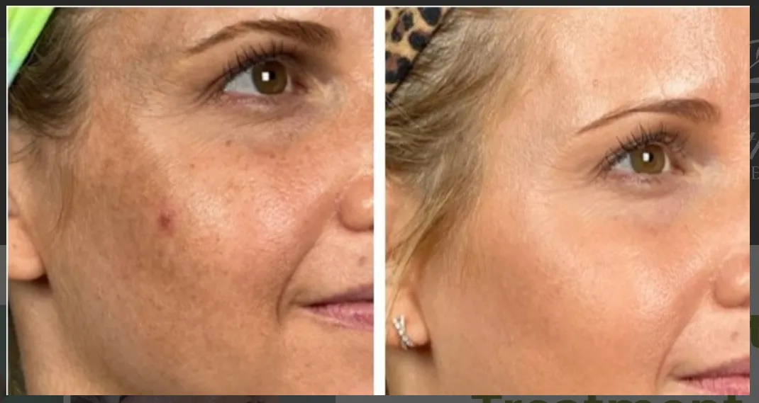 Facial treatment before and after - side view