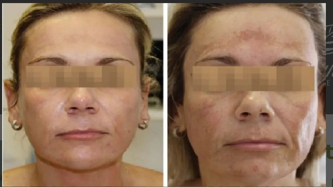 Facial treatment before and after - front view