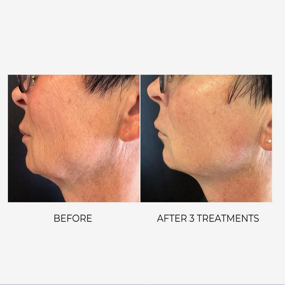 Face / Neck